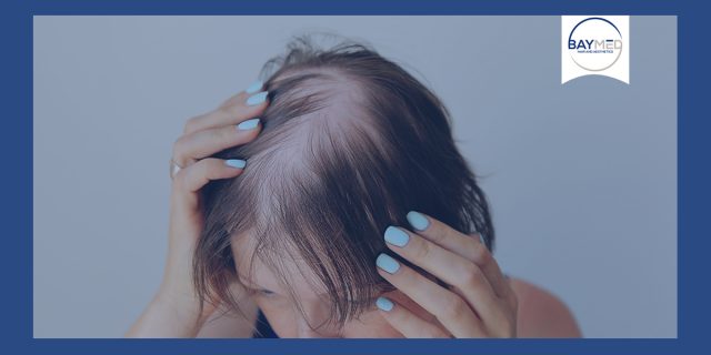 Androgenic alopecia