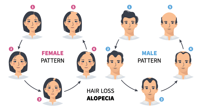 Hair Loss Alopecia diagram