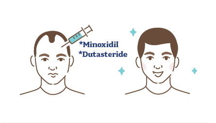 Minoxidil/Dutasteride treatment
