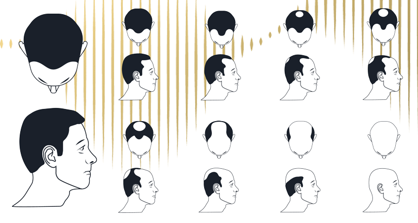 Norwood hair loss scale