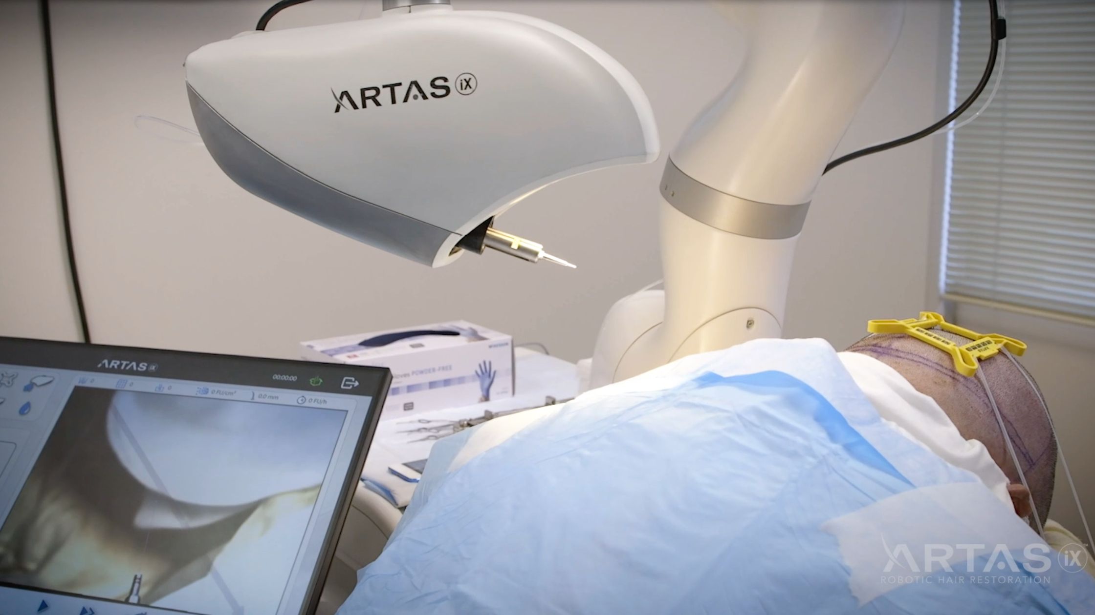 artas robotic hair procedure patient