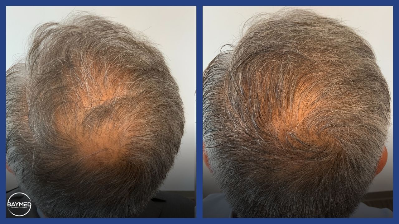 before and after photos hair loss