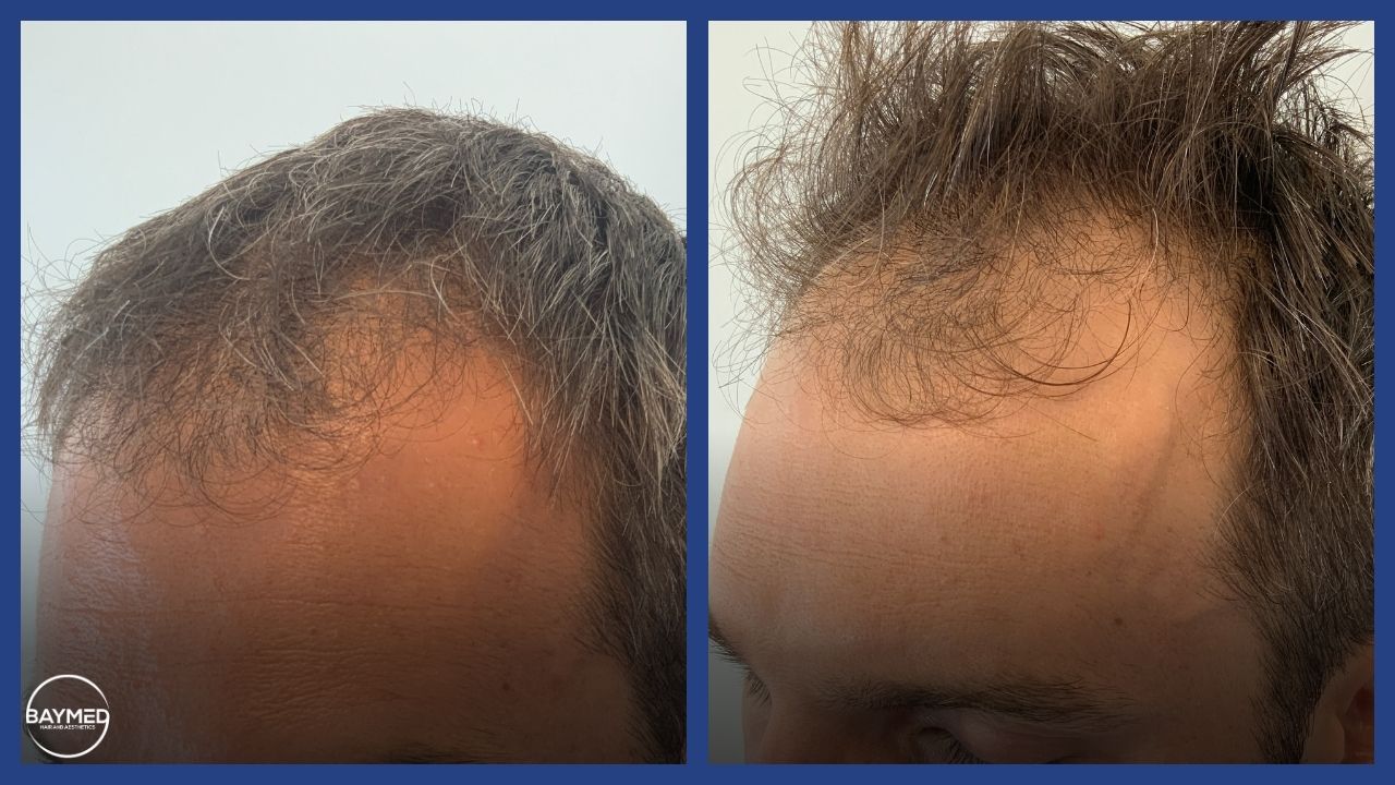 before and after photos hair loss