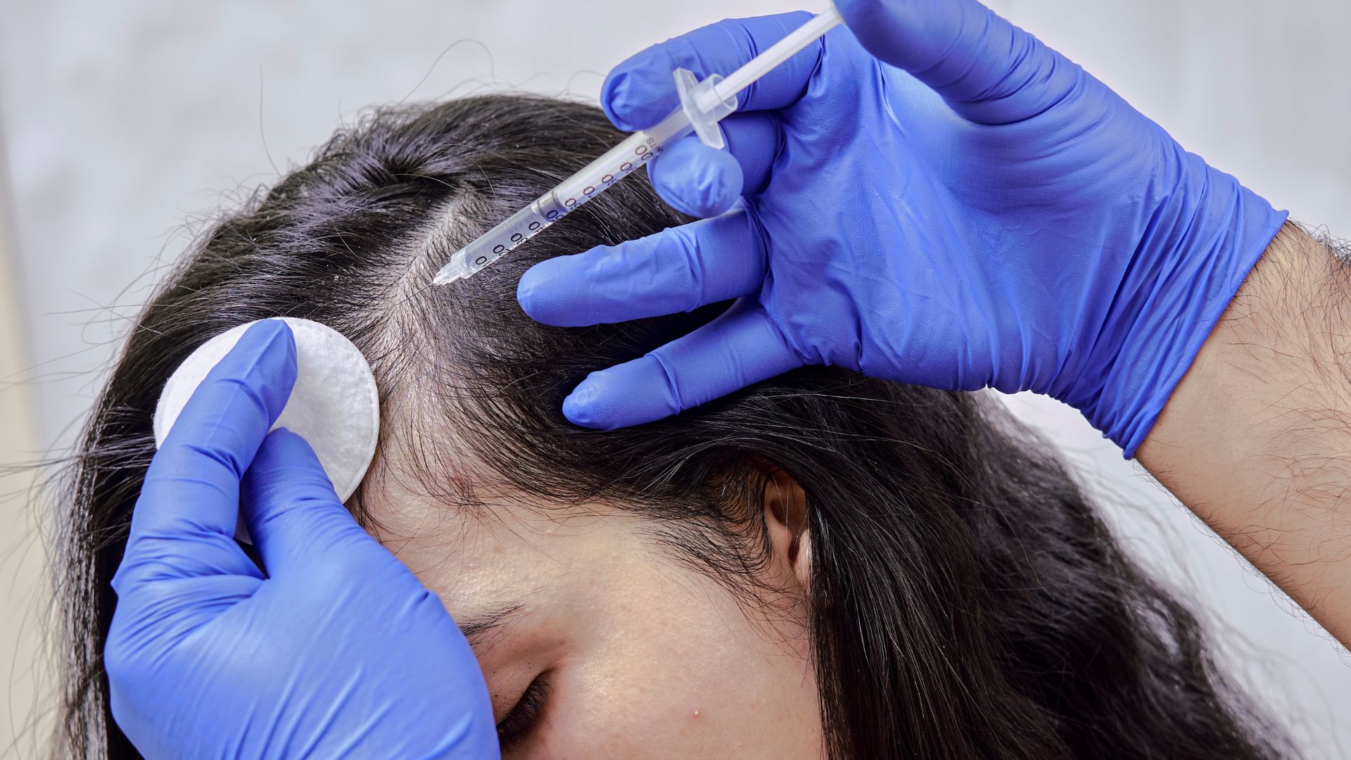 non surgical hair restoration