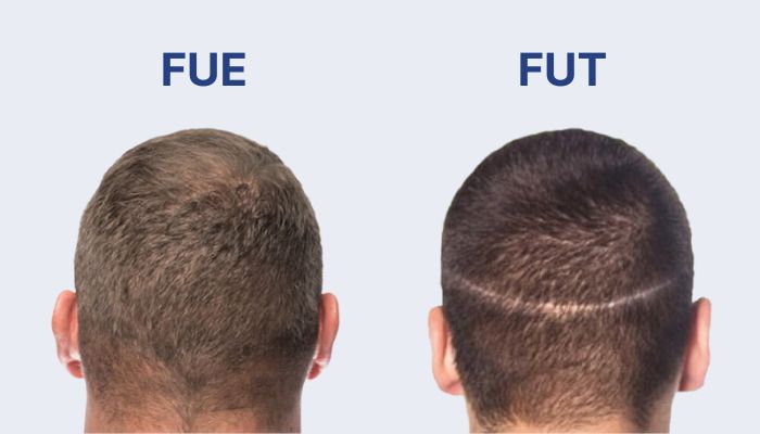 FUE vs. FUT: Uncover the Key Differences Between These Hair Restoration Techniques