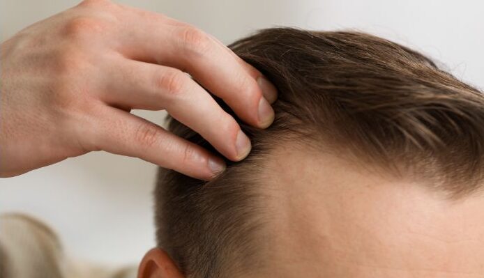 Early Signs of Hair Loss