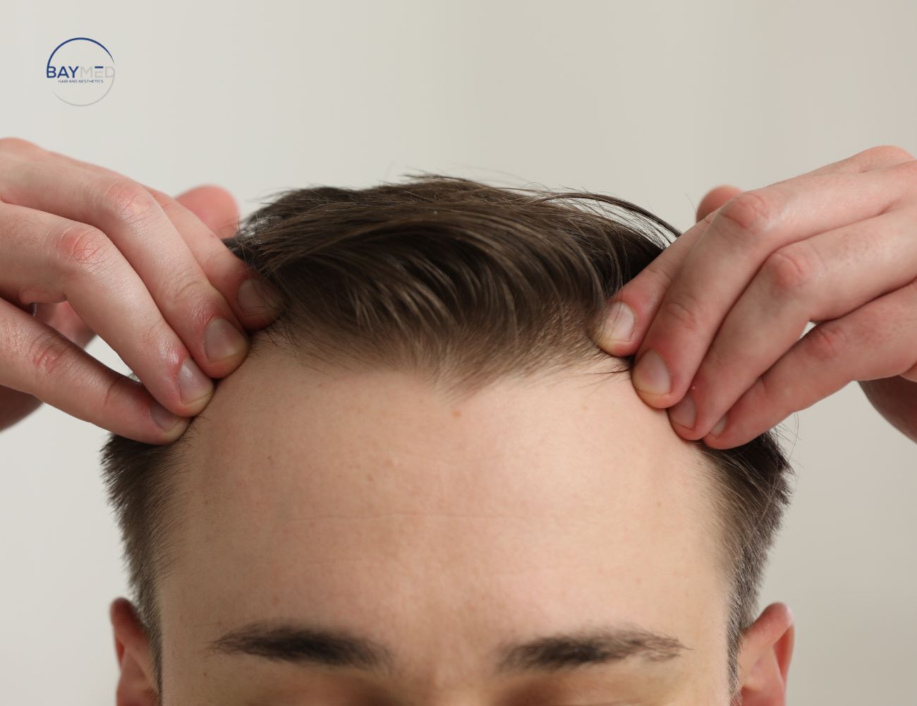 Discover the Early Signs of Hair Loss