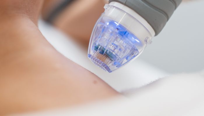 Virtue RF Microneedling Florida