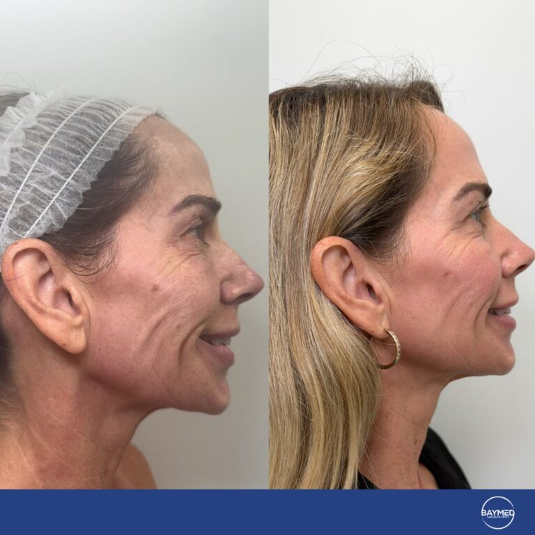 baymed co2 laser before and after