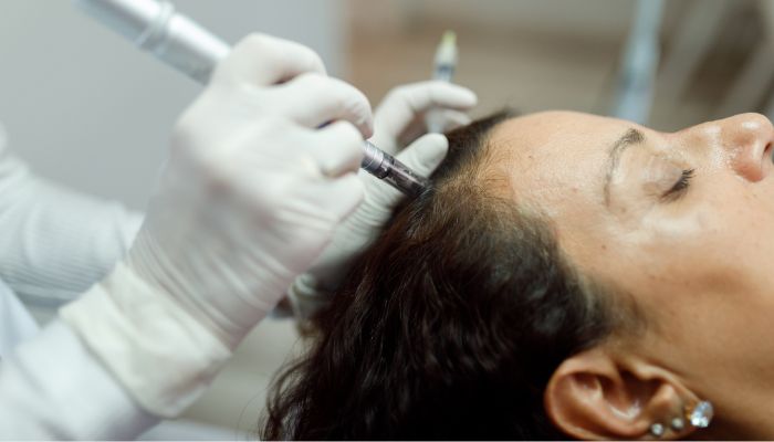 Microneedling for hair growth in St. Petersburg, Florida