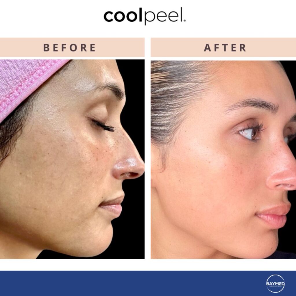 baymed co2 laser before and after