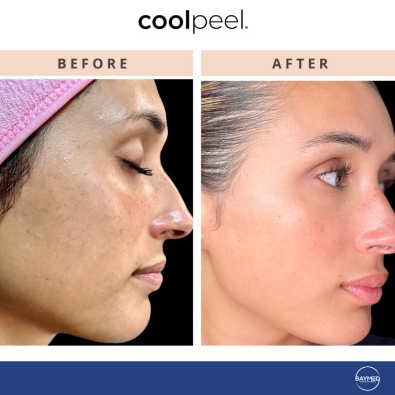 baymed co2 laser before and after