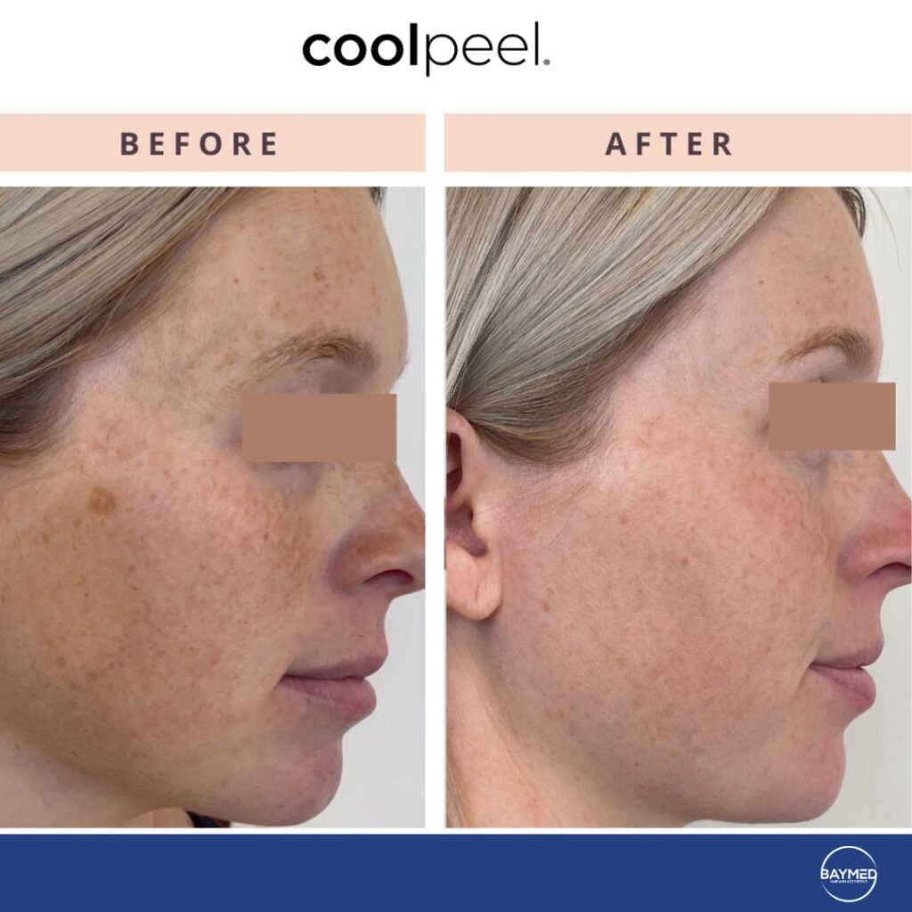 baymed co2 laser before and after