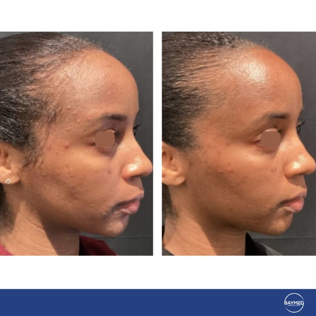before and after laser co21