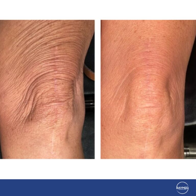 before and after laser co21