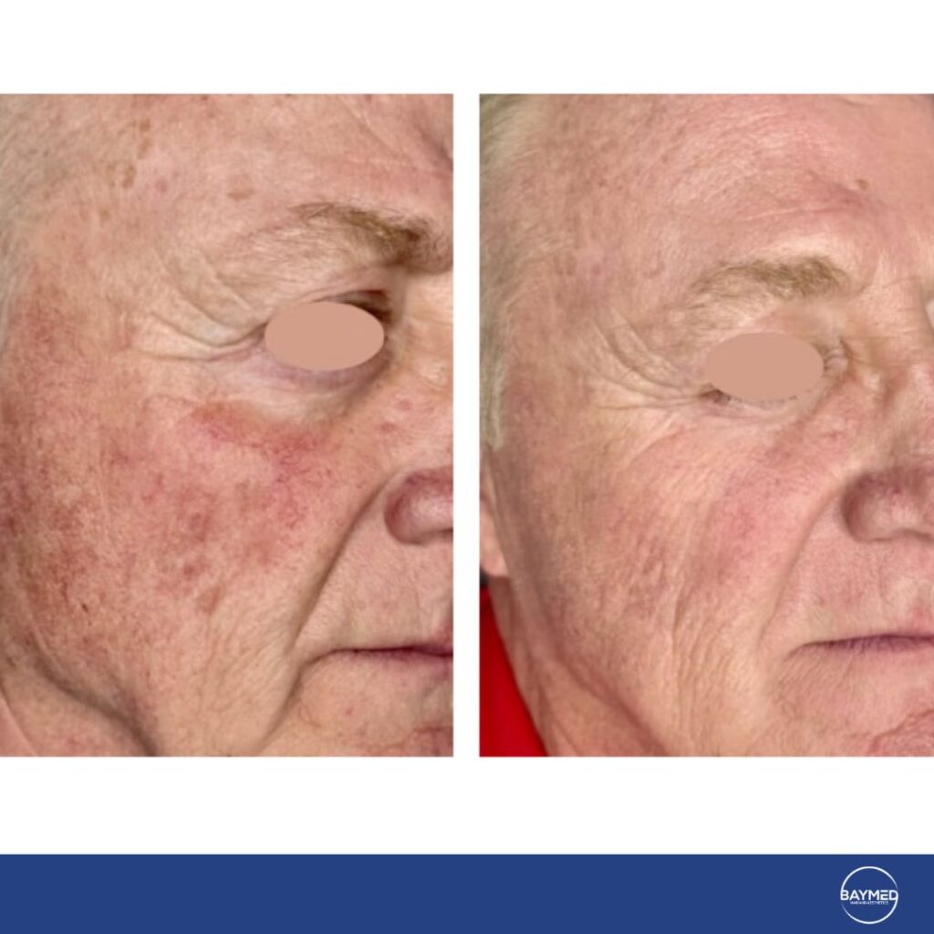 before and after laser co21