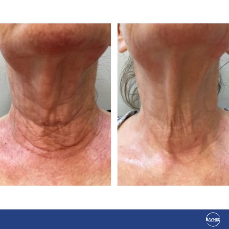 before and after laser co21
