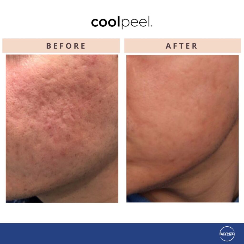 tetra co2 coolpeel before and after1