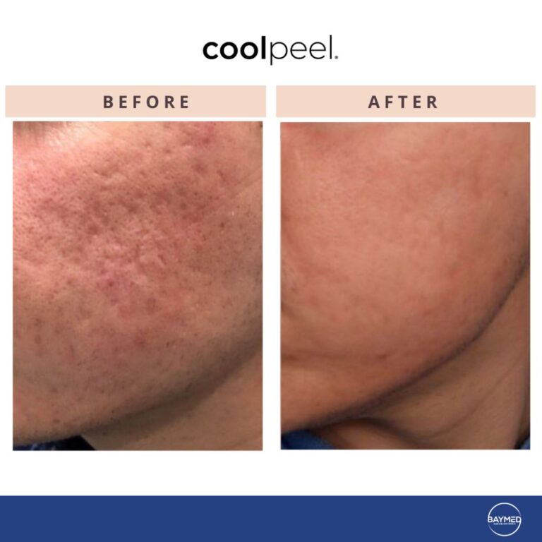 tetra co2 coolpeel before and after1