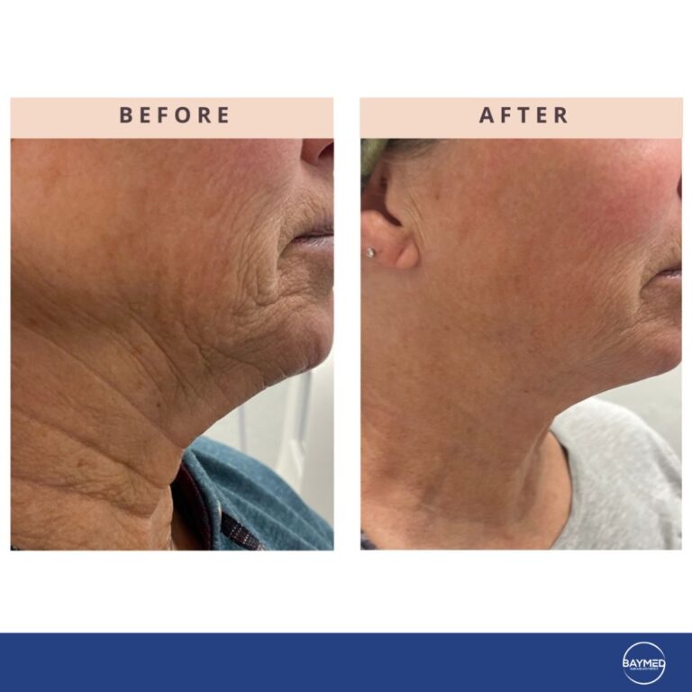 tetra co2 coolpeel before and after1