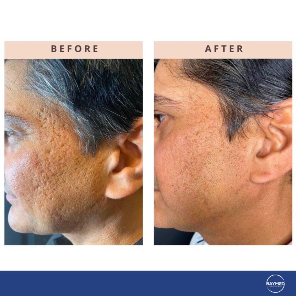 tetra co2 coolpeel before and after1