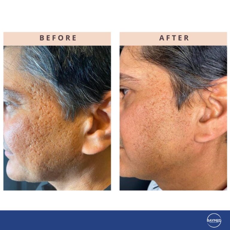 tetra co2 coolpeel before and after1