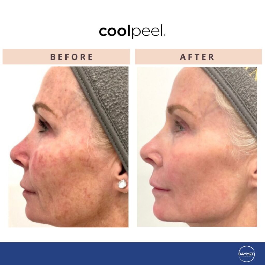 tetra co2 coolpeel before and after1