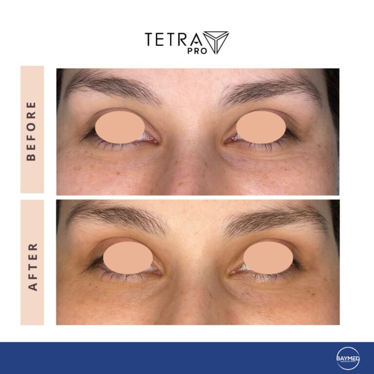 tetra co2 coolpeel before and after1