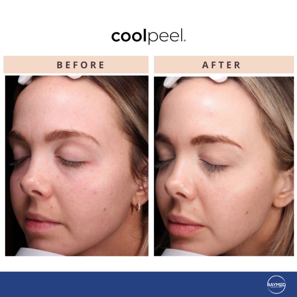 tetra co2 coolpeel before and after1