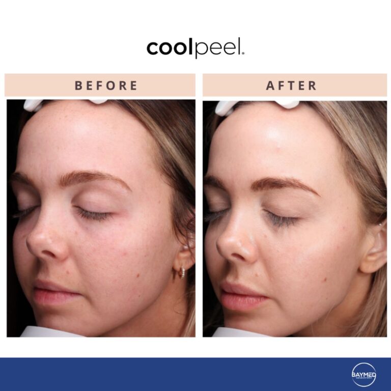 tetra co2 coolpeel before and after1