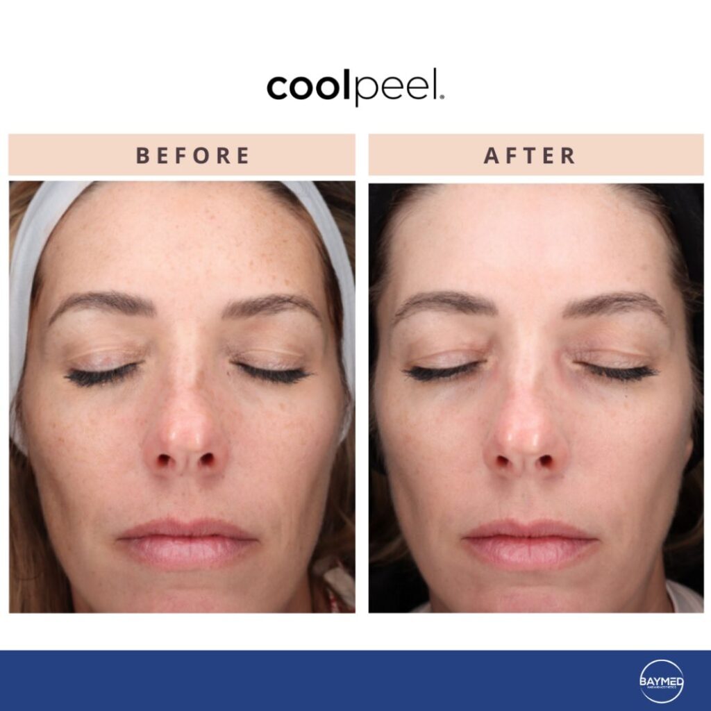 tetra co2 coolpeel before and after1