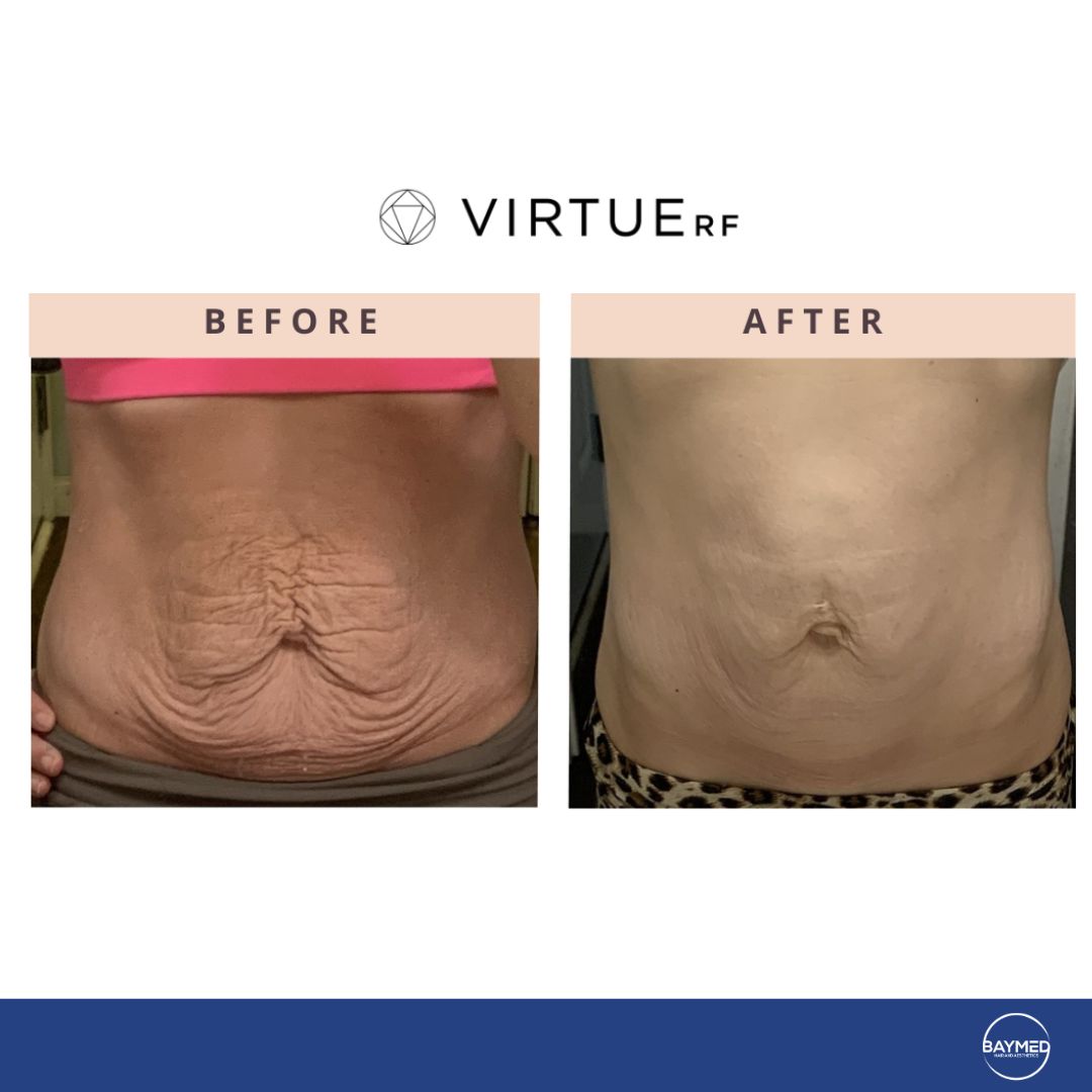 co2 laser for body skin tightening2