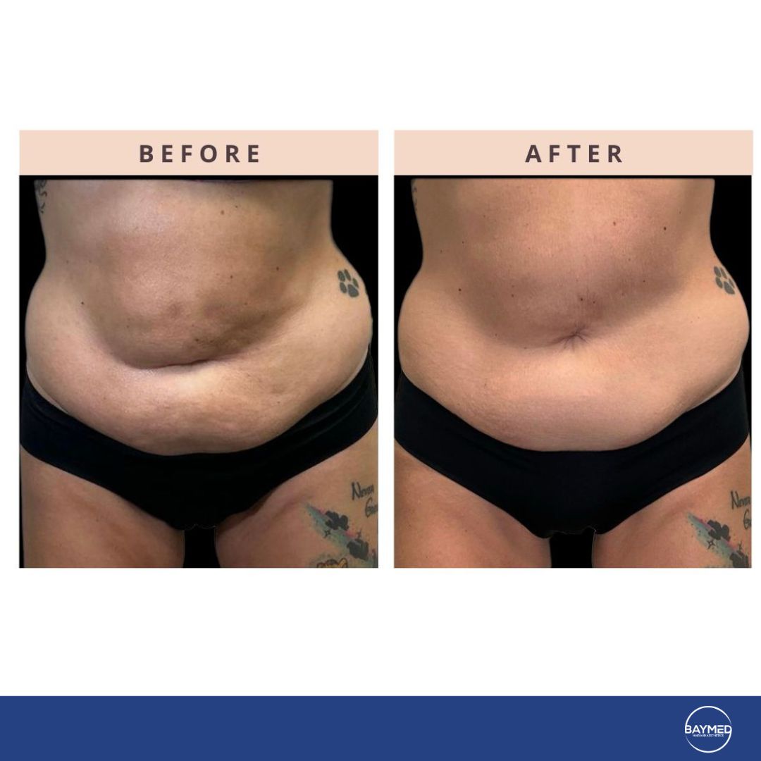 co2 laser for body skin tightening3