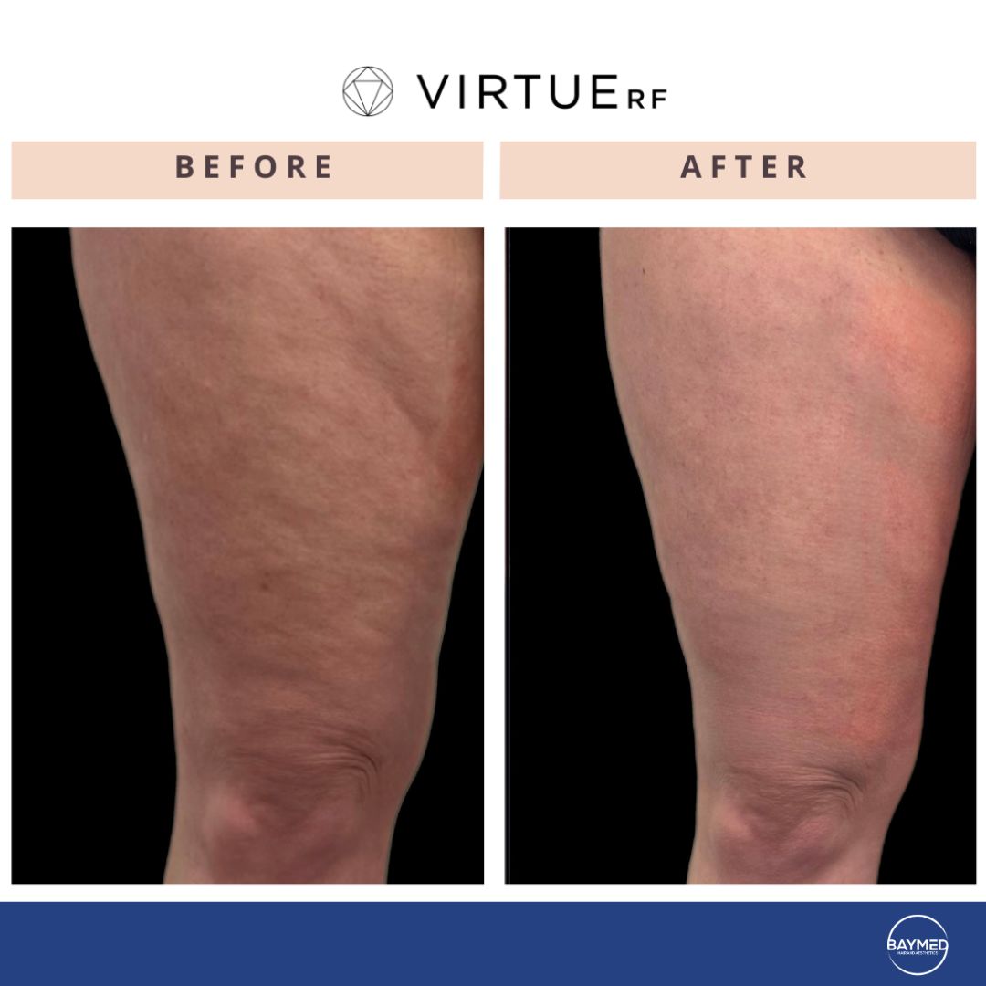 co2 laser for body skin tightening4