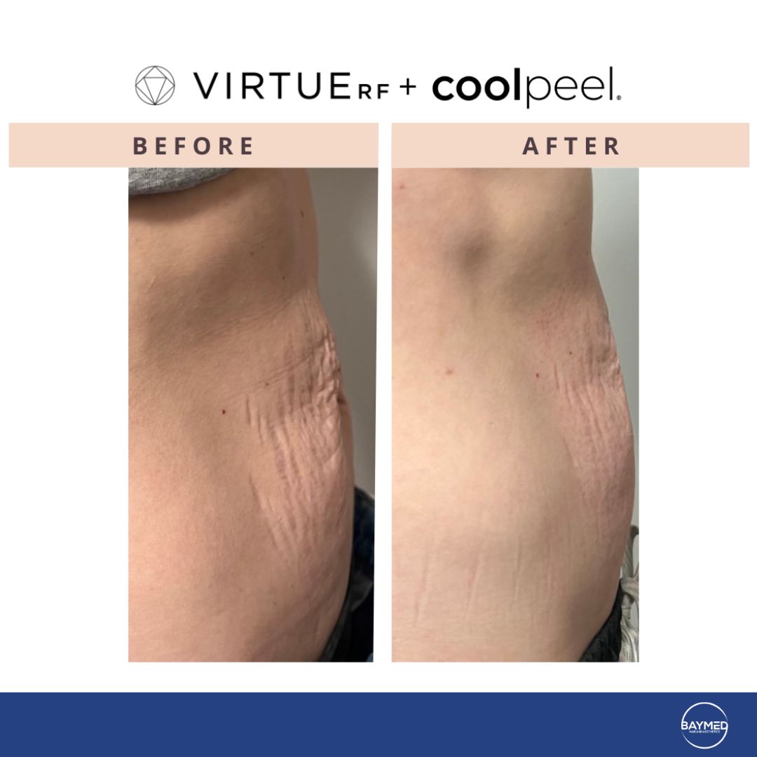 co2 laser for body skin tightening5