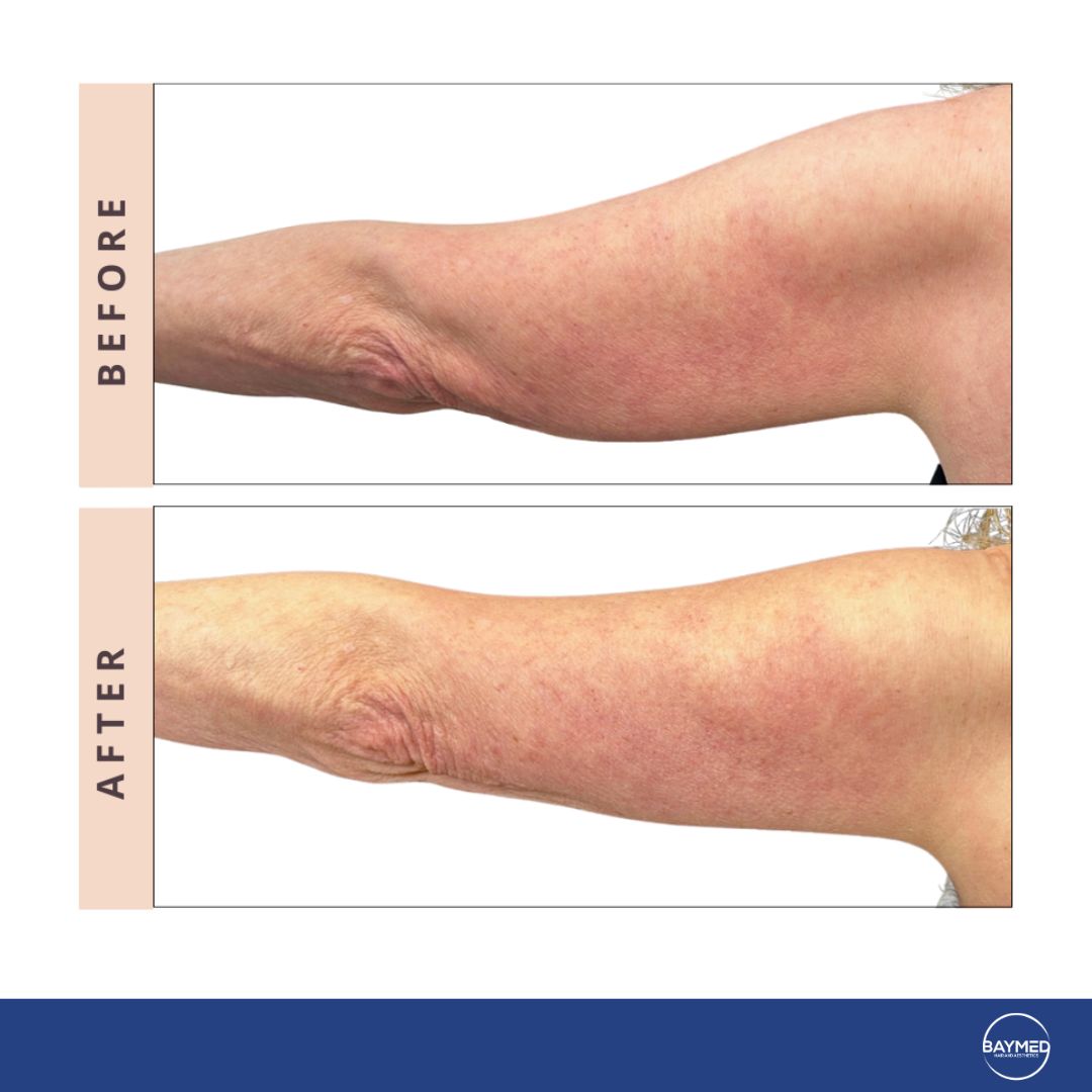 co2 laser for body skin tightening6