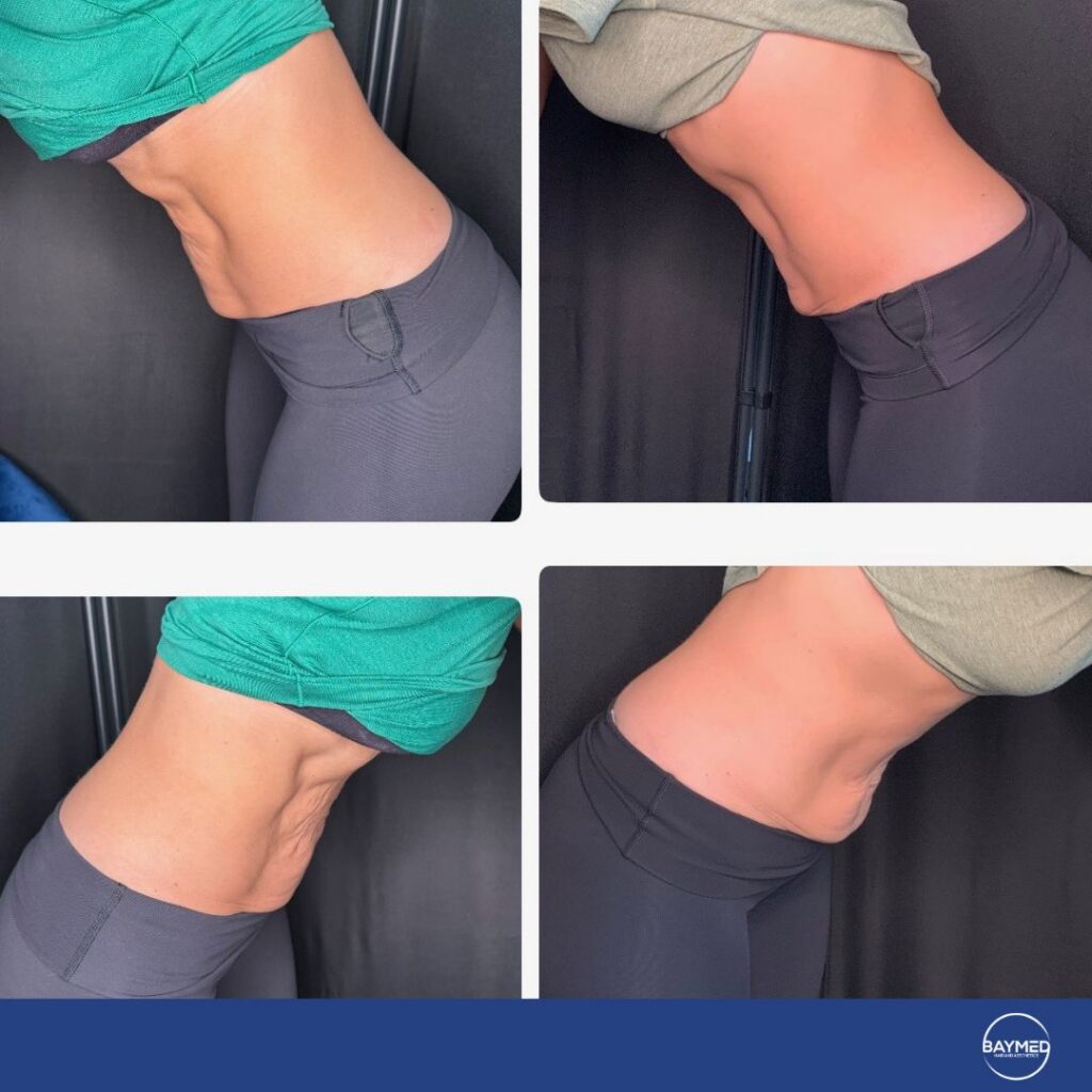 co2 laser for body skin tightening before and after