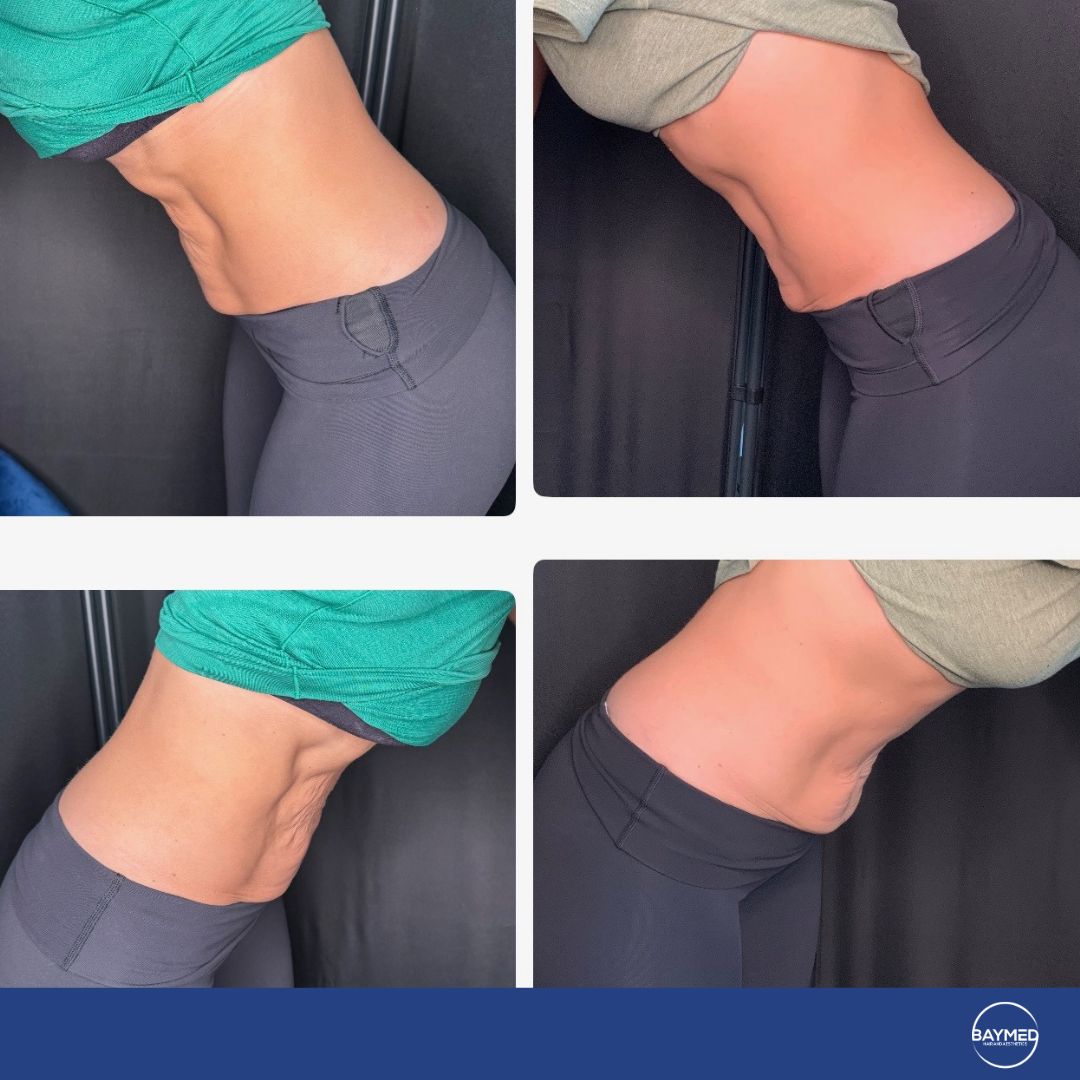 co2 laser for body skin tightening before and after