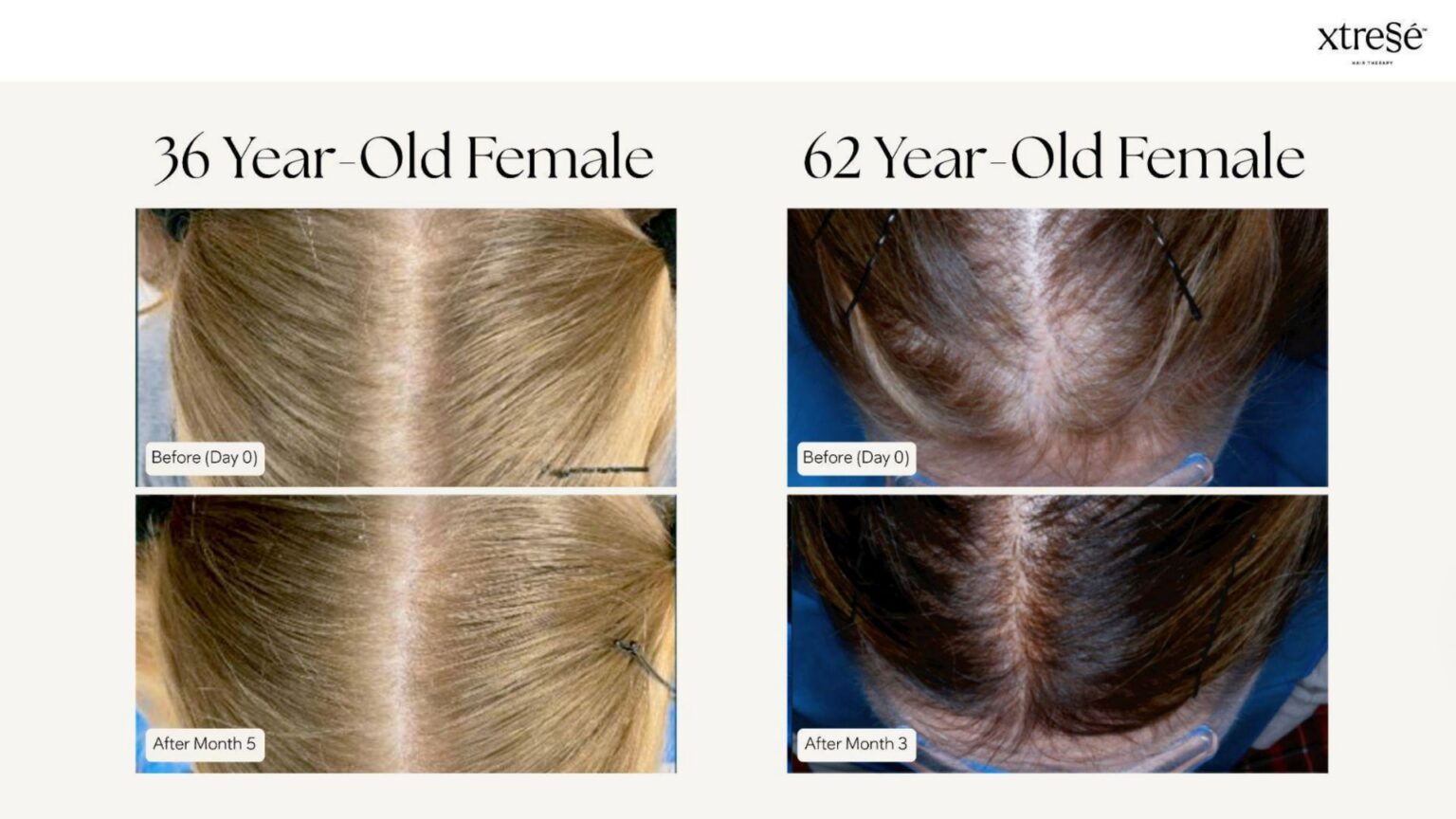 Xtressé Hair Therapy - before and after1