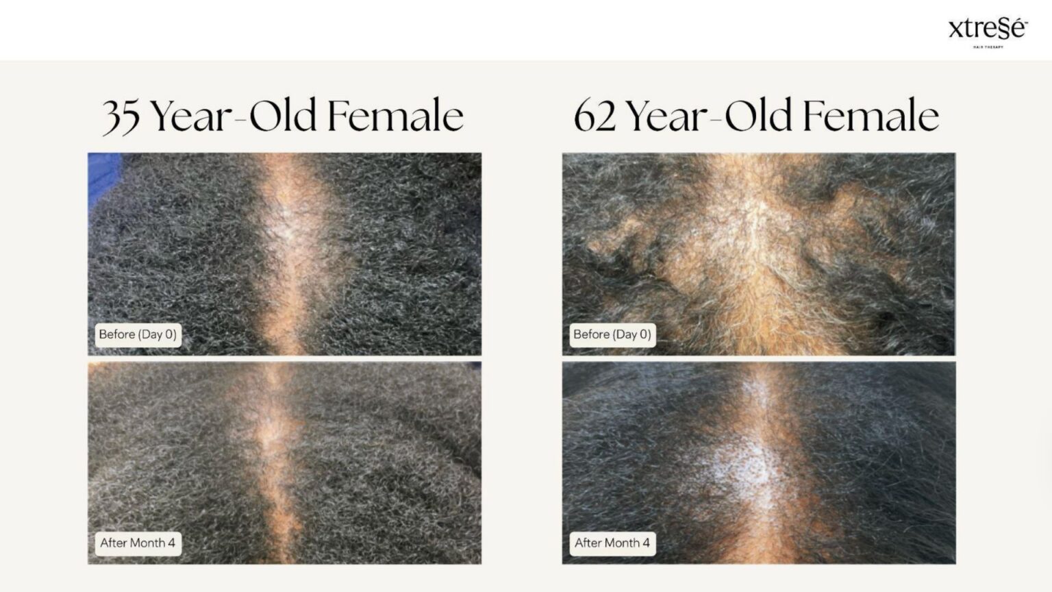 Xtressé Hair Therapy - before and after2