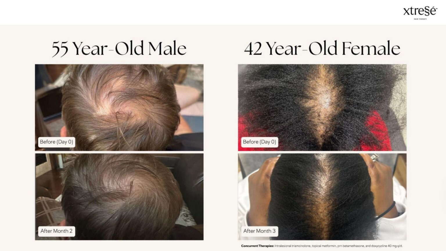 Xtressé Hair Therapy - before and after3