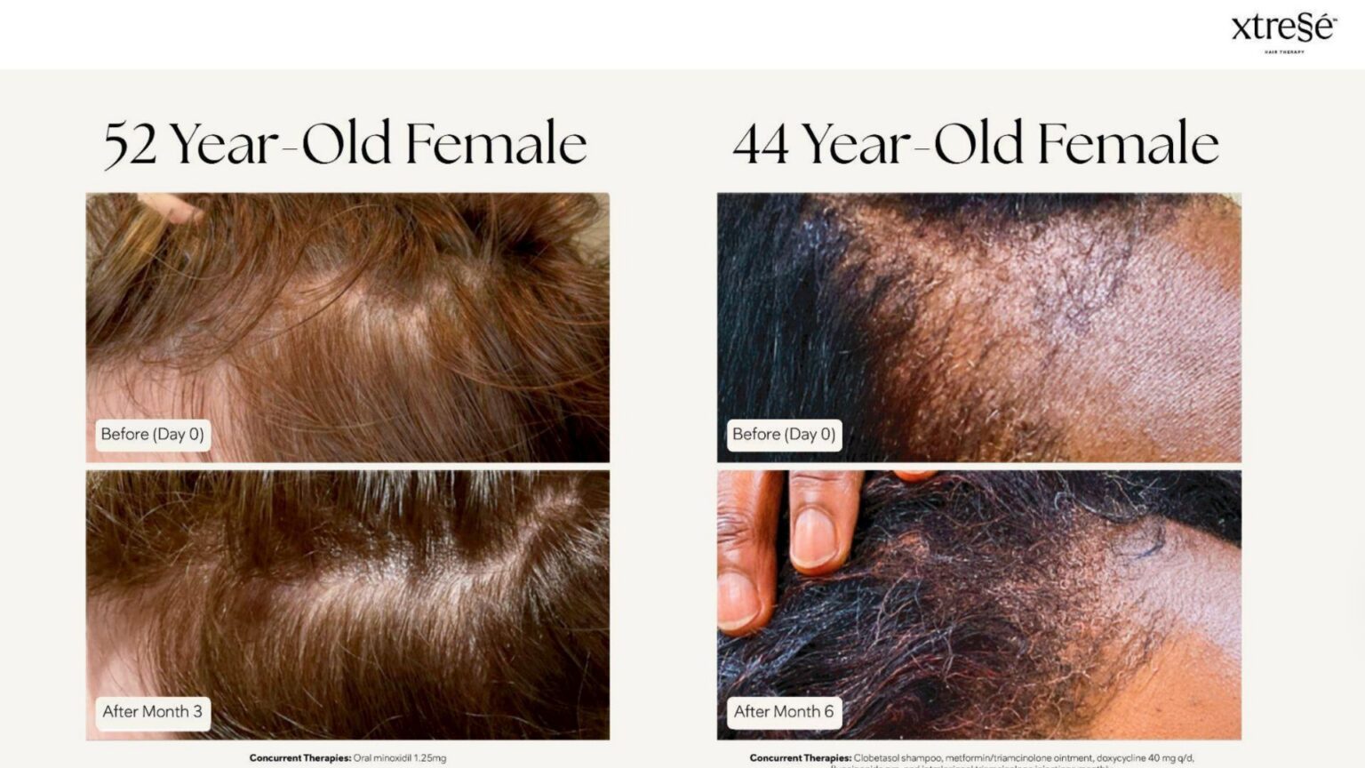 Xtressé Hair Therapy - before and after5