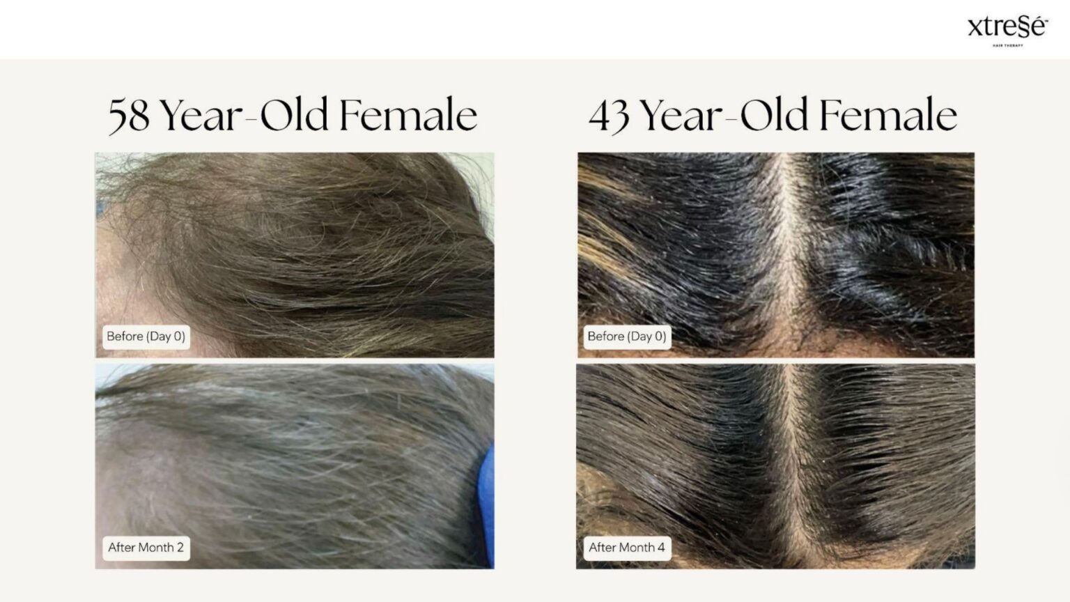 Xtressé Hair Therapy - before and after8