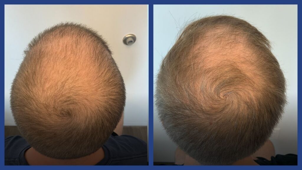before and after hair restoration1