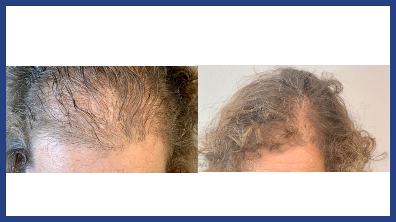 before and after hair restoration1