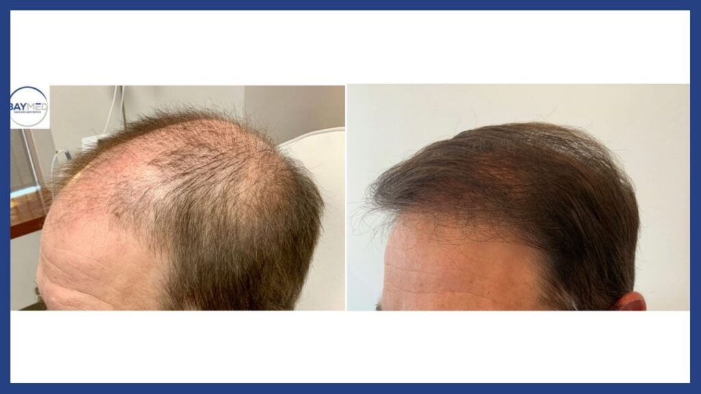 before and after hair restoration1