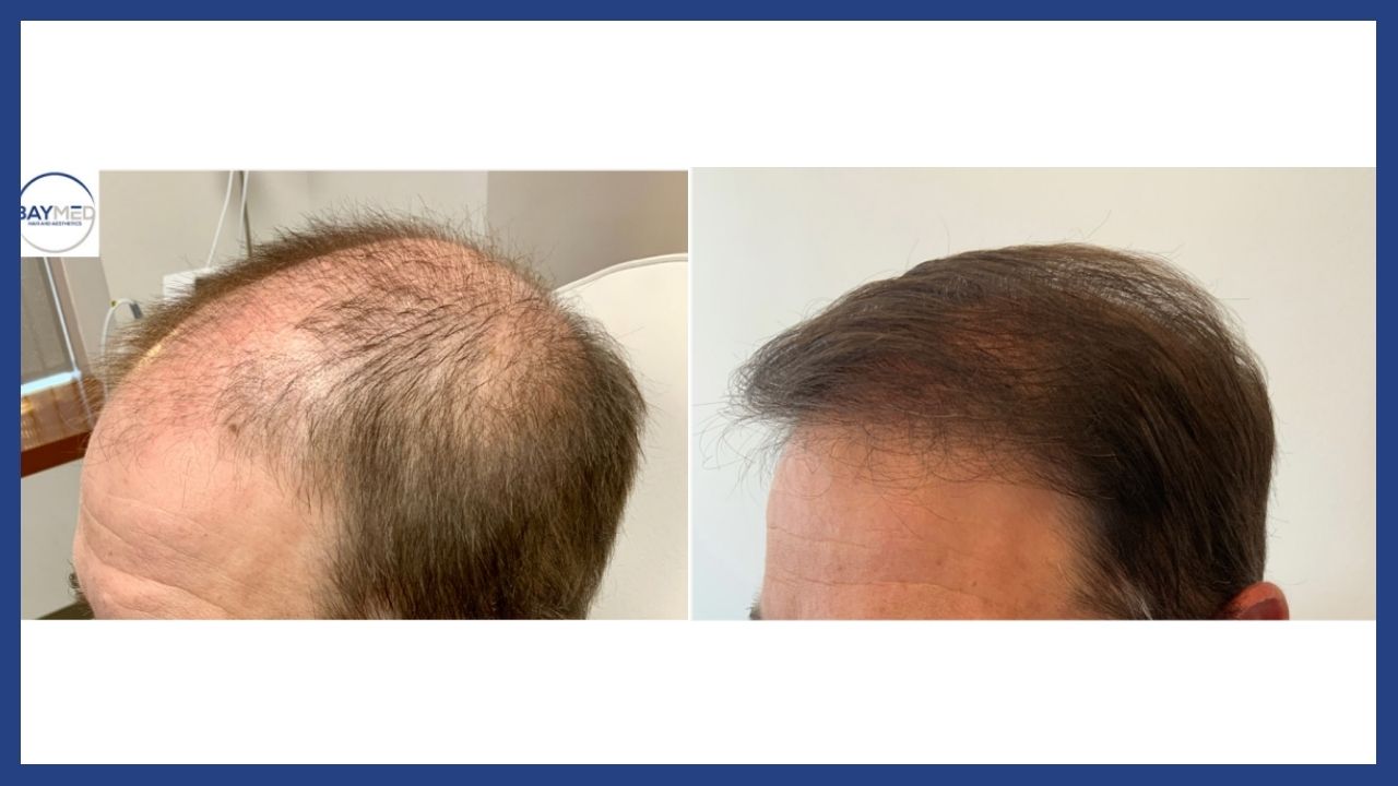 before and after hair restoration1