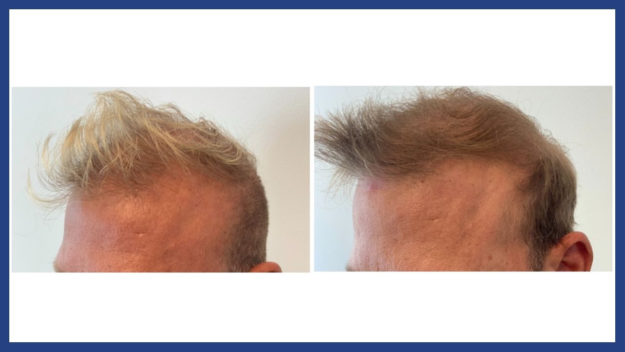 before and after hair restoration1