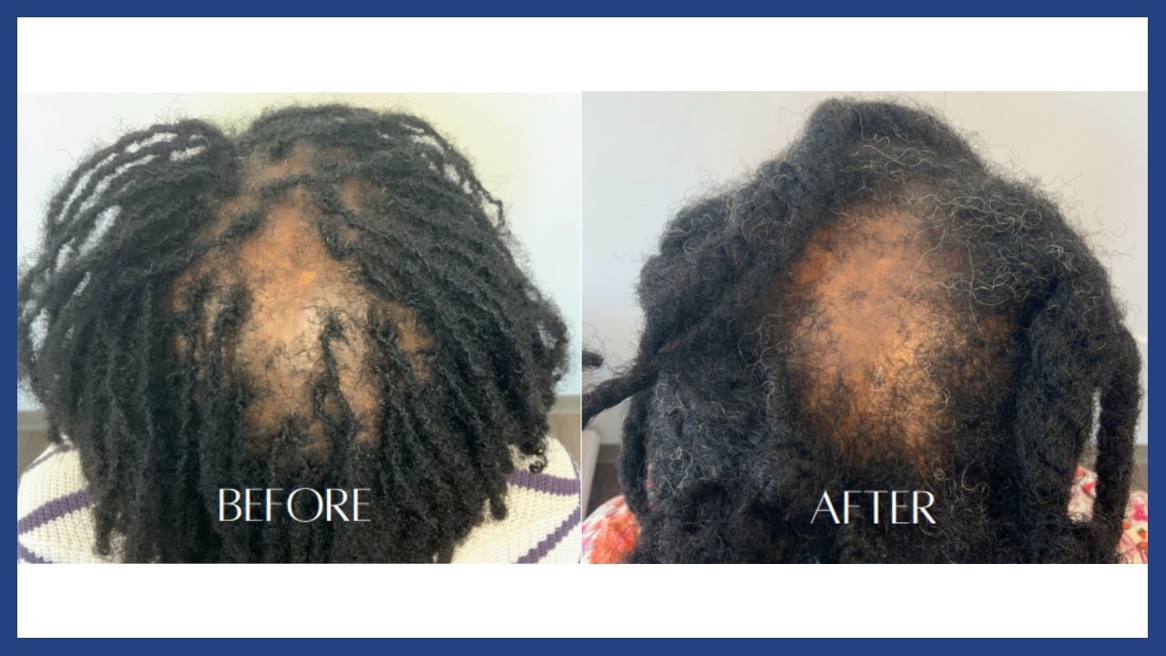 before and after hair restoration1