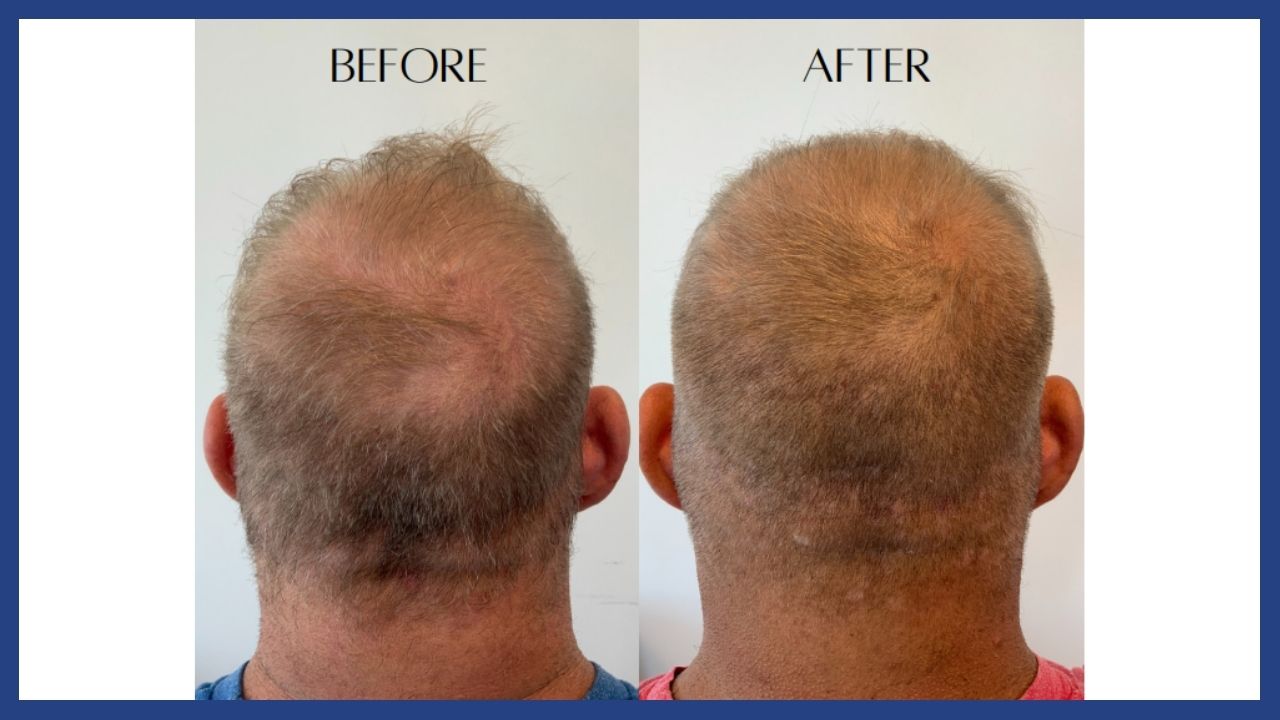 before and after hair restoration1